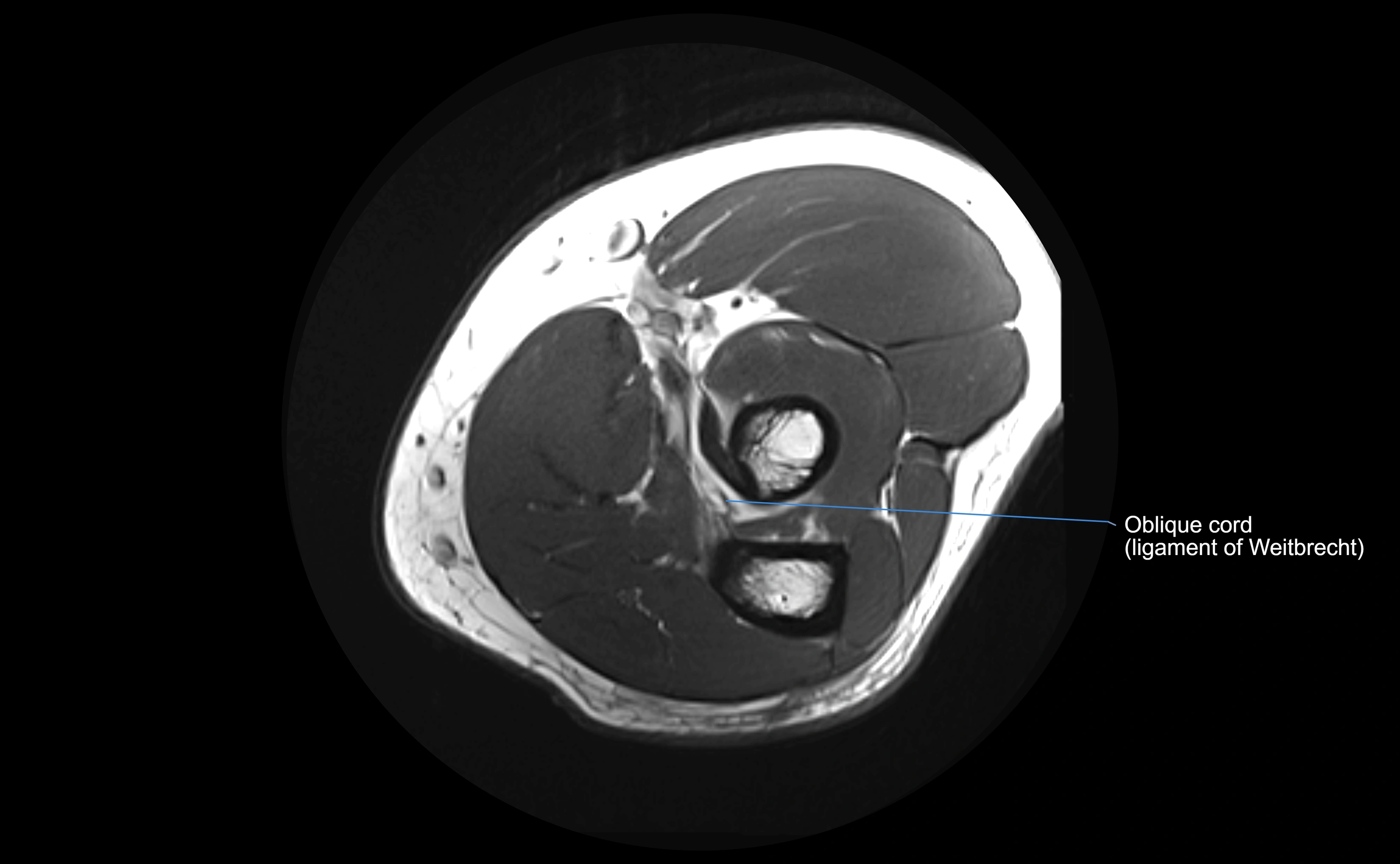 MRI elbow ligaments axial cross sectional anatomy 3T  radiology  image-img-00001-00023.webp